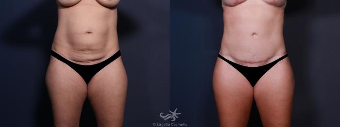 Before & After Tummy Tuck Result 636 Front View in San Diego, Carlsbad, CA
