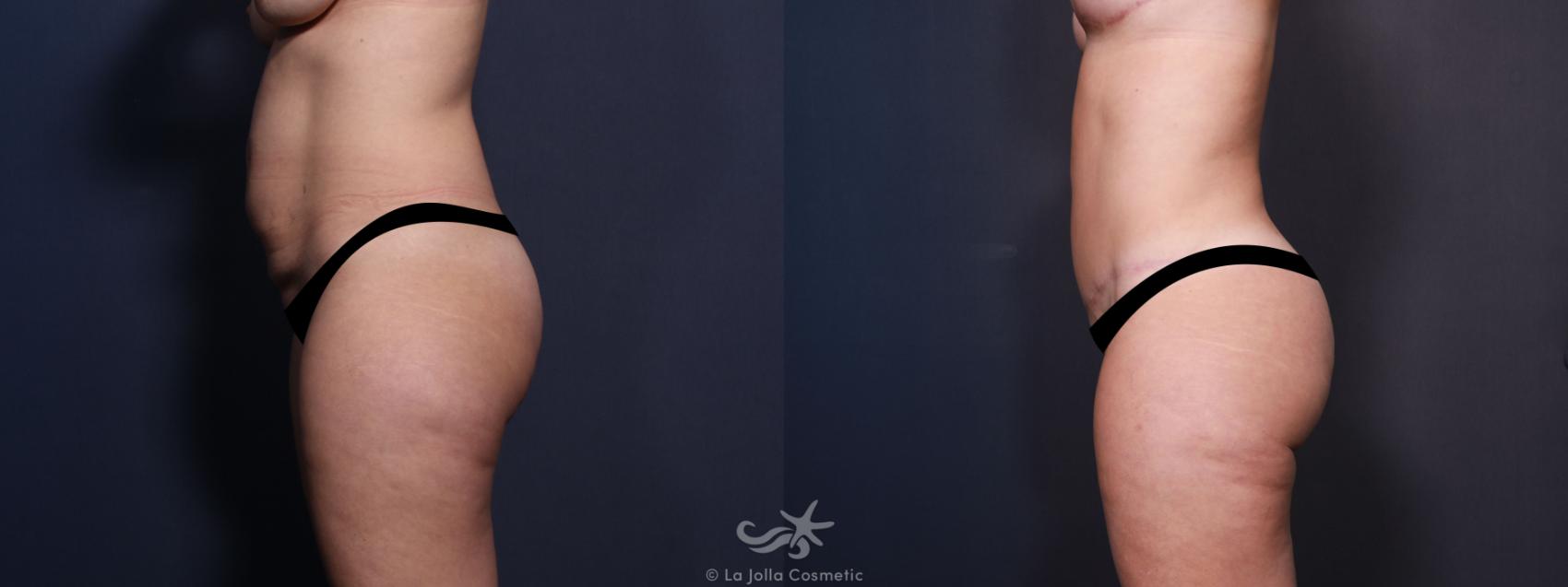 Before & After Fat Transfer Body Result 636 Left Side View in San Diego, CA