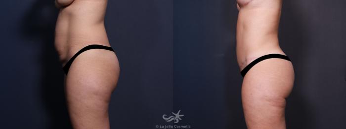 Before & After Tummy Tuck Result 636 Left Side View in San Diego, Carlsbad, CA