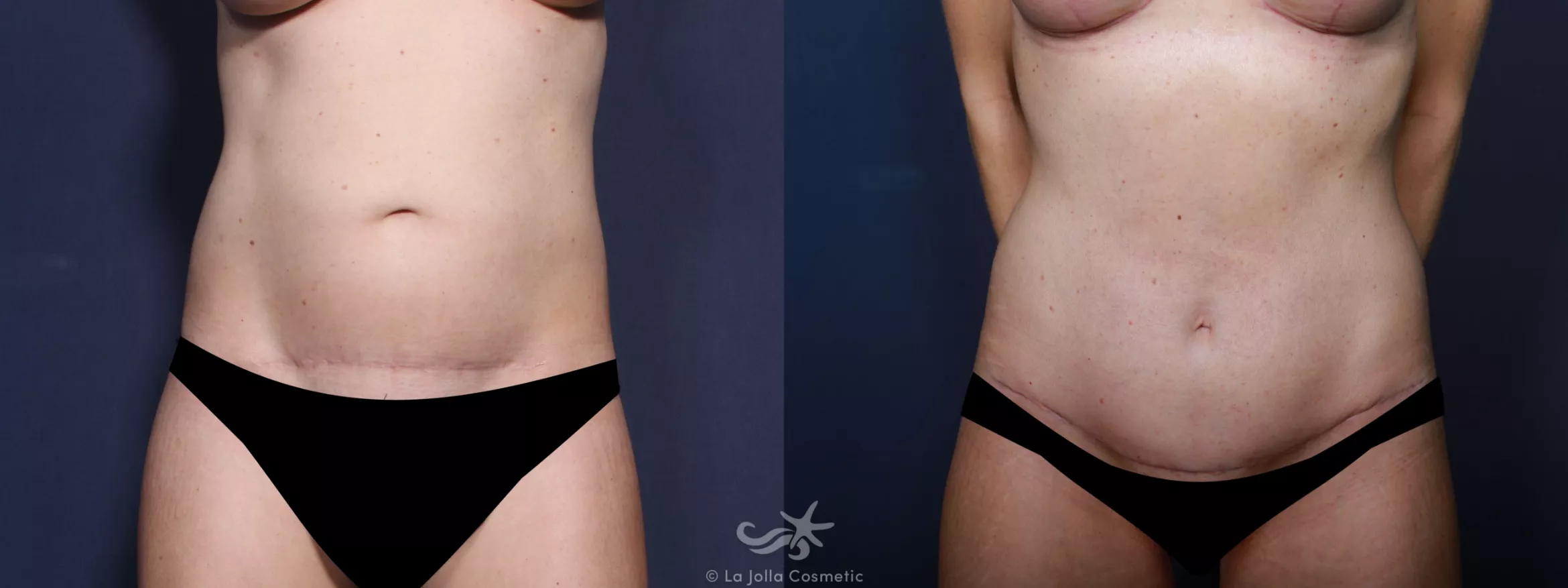 Before & After Tummy Tuck Result 659 Front View in San Diego, CA