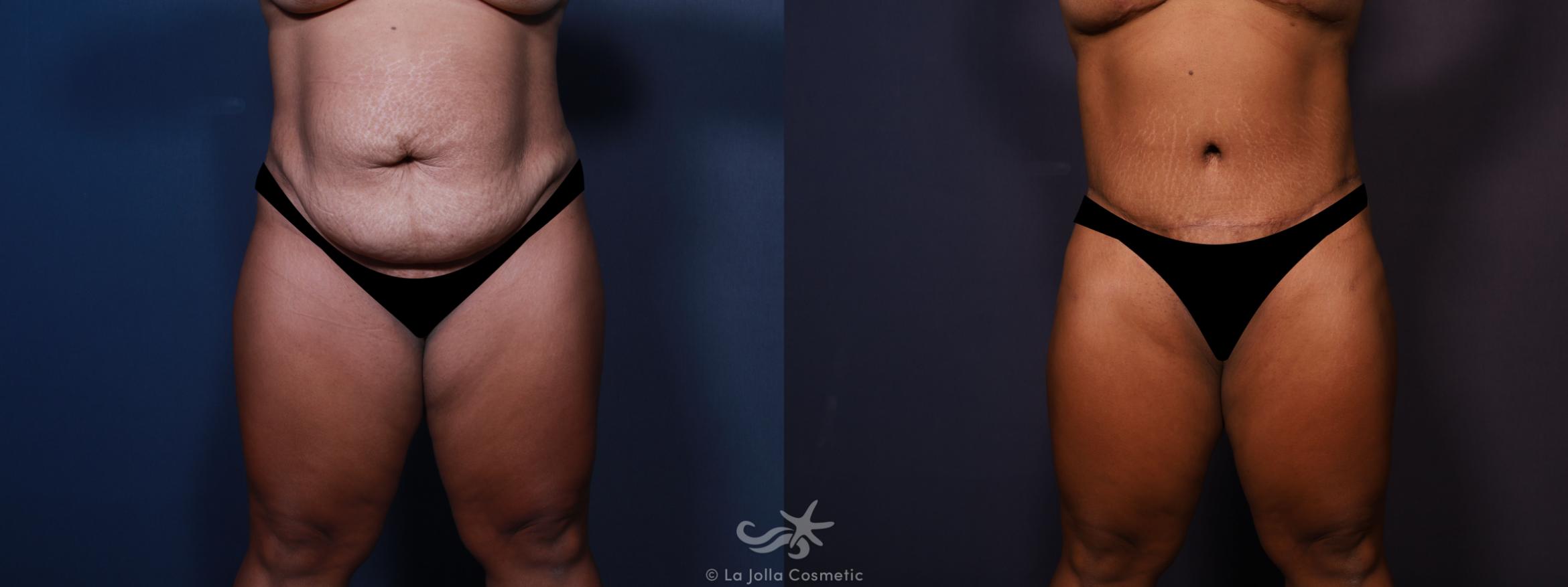 Before & After Tummy Tuck Result 665 Front View in San Diego, CA