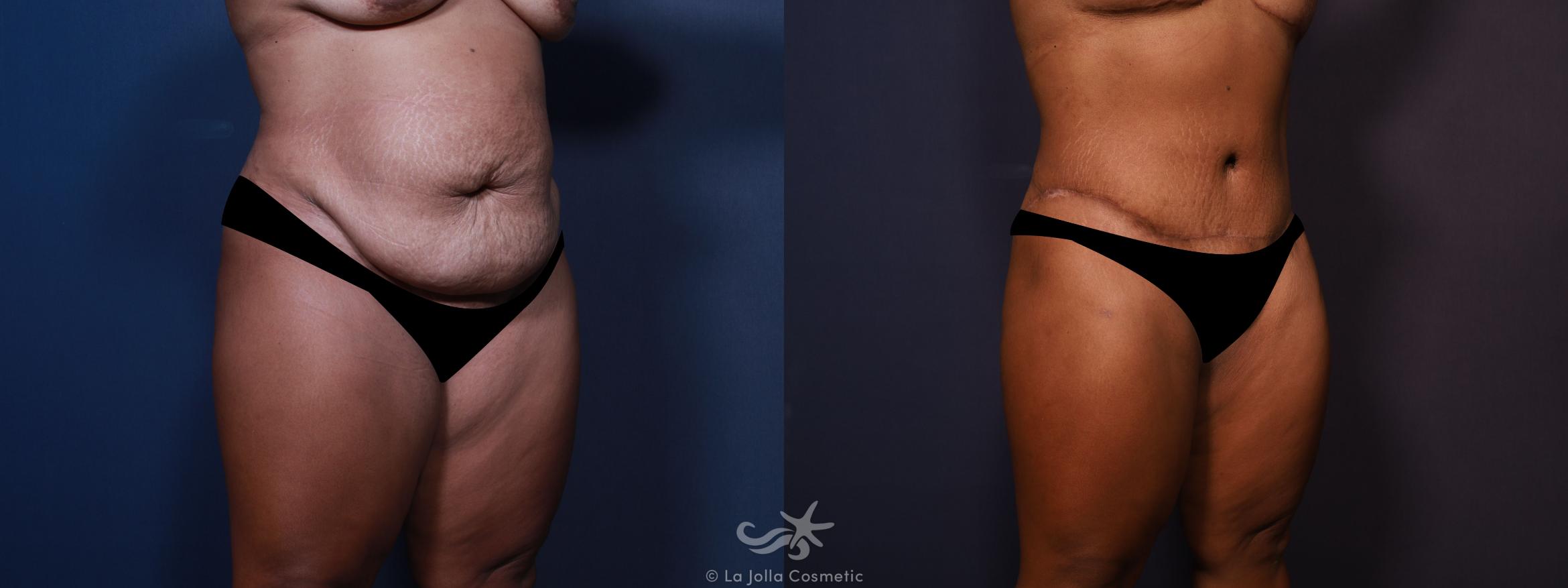 Before & After Tummy Tuck Result 665 Right Oblique View in San Diego, CA