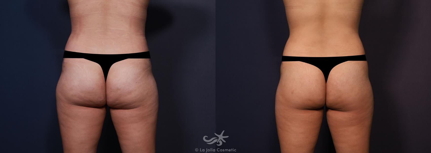 Before & After Tummy Tuck Result 681 Back View in San Diego, CA