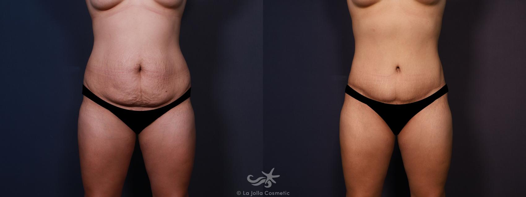 Before & After Tummy Tuck Result 681 Front View in San Diego, CA