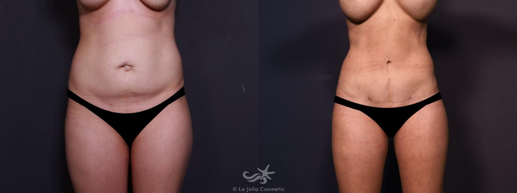 Before & After Tummy Tuck Result 682 Front View in San Diego, CA