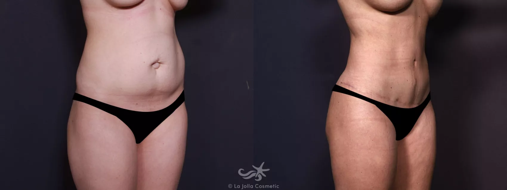 Before & After Tummy Tuck Result 682 Right Oblique View in San Diego, CA
