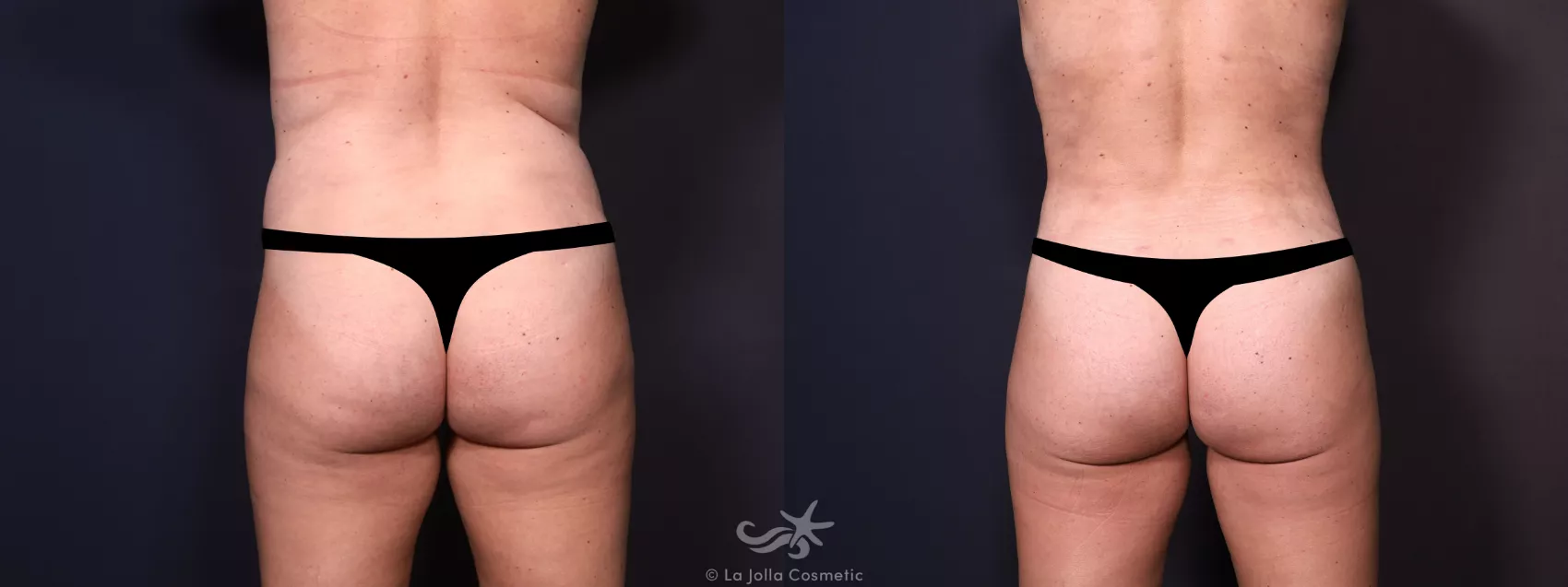 Before & After Tummy Tuck Result 683 Back View in San Diego, CA