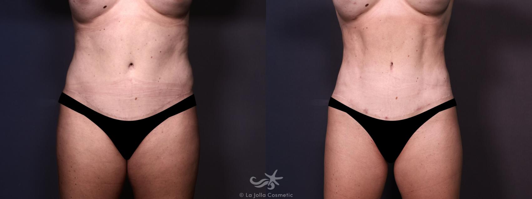 Before & After Tummy Tuck Result 683 Front View in San Diego, CA