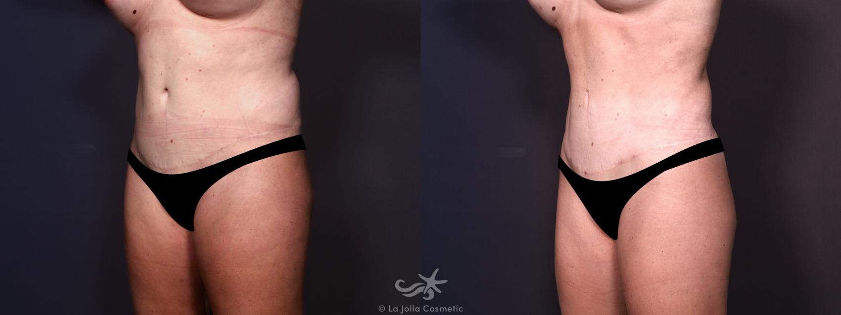 Before & After Tummy Tuck Result 683 Left Oblique View in San Diego, CA