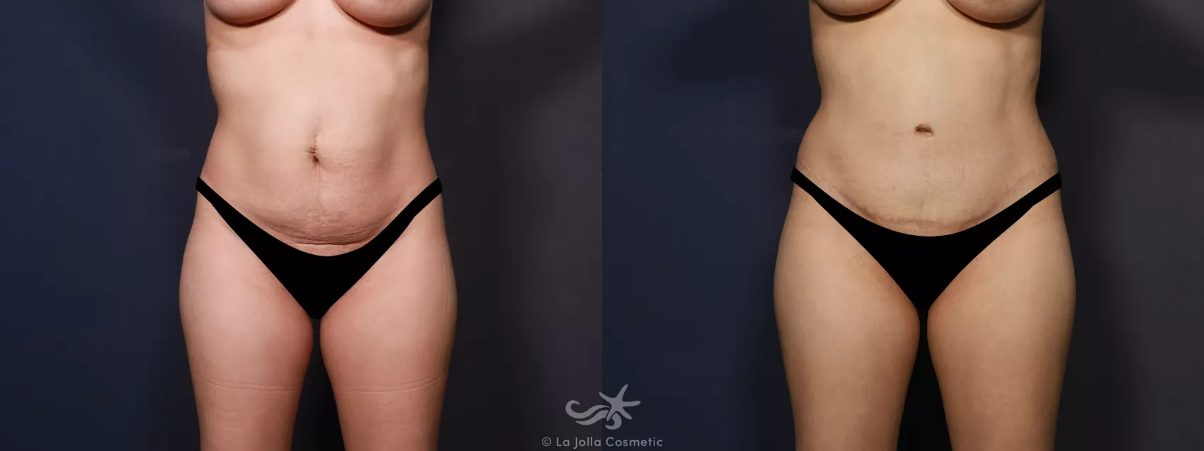 Before & After Tummy Tuck Result 741 Front View in San Diego, CA