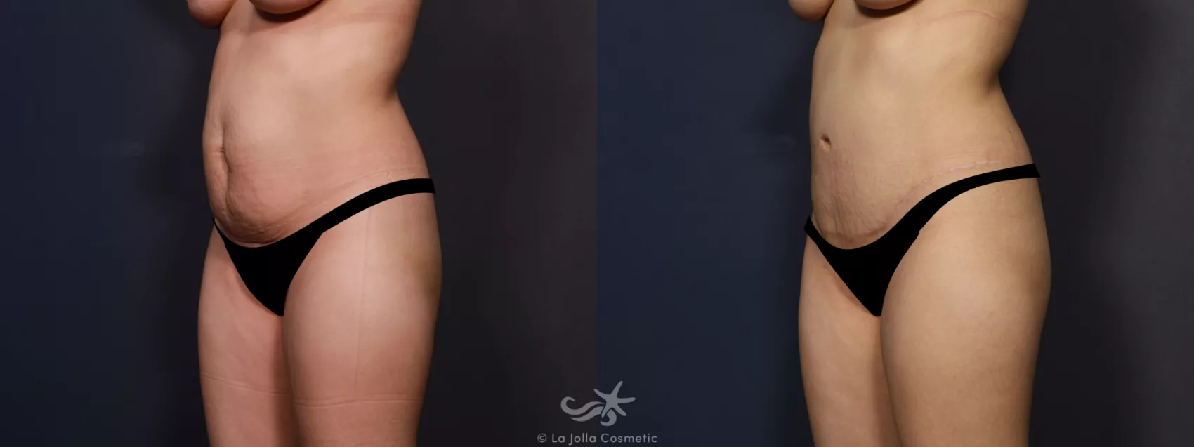 Before & After Tummy Tuck Result 741 Left Oblique View in San Diego, CA
