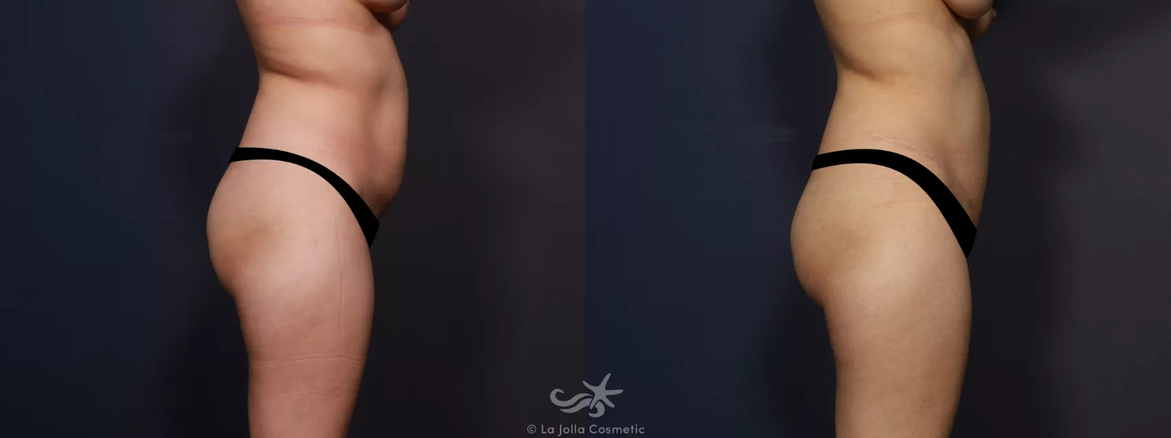 Before & After Tummy Tuck Result 741 Right Side View in San Diego, CA