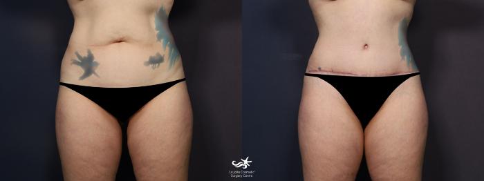 Tummy Tuck Before and After Photo Gallery, San Diego, CA