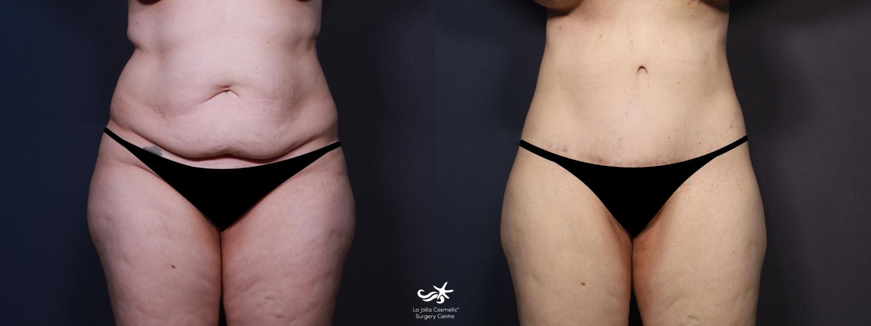 Before & After Tummy Tuck Result 882 Front View in San Diego, CA