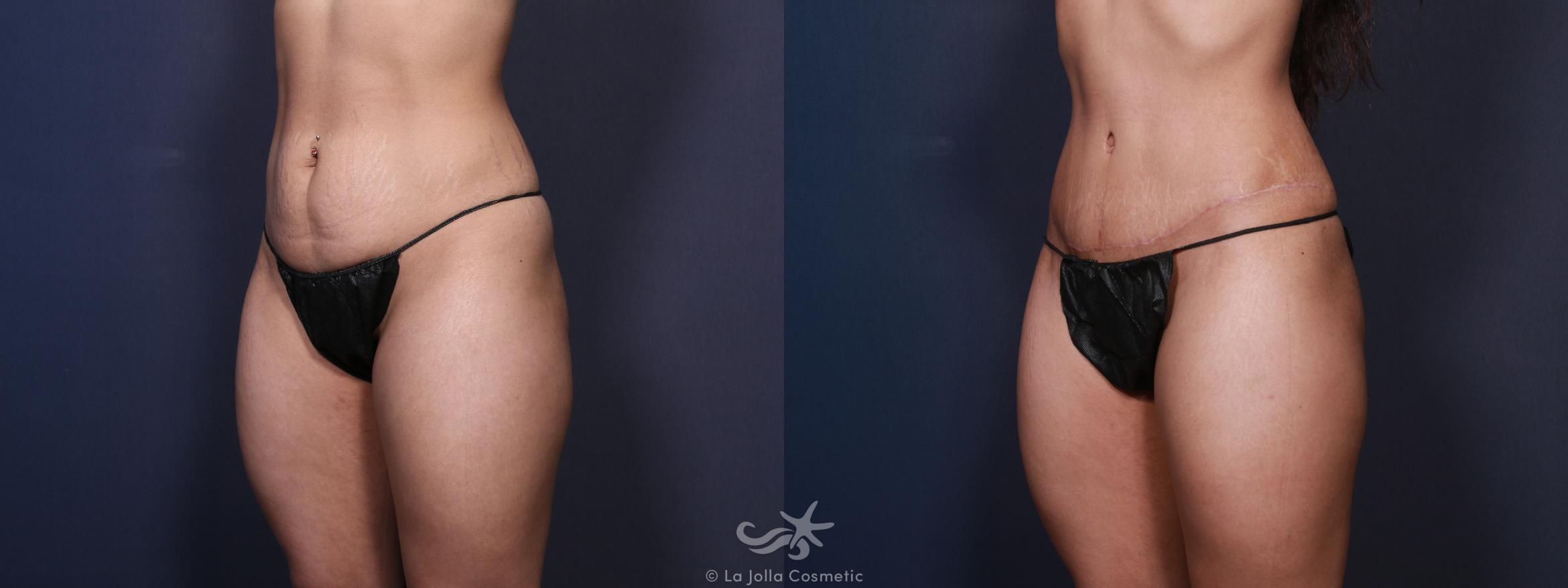 Before & After Liposuction Result 95 Left Oblique View in San Diego, CA