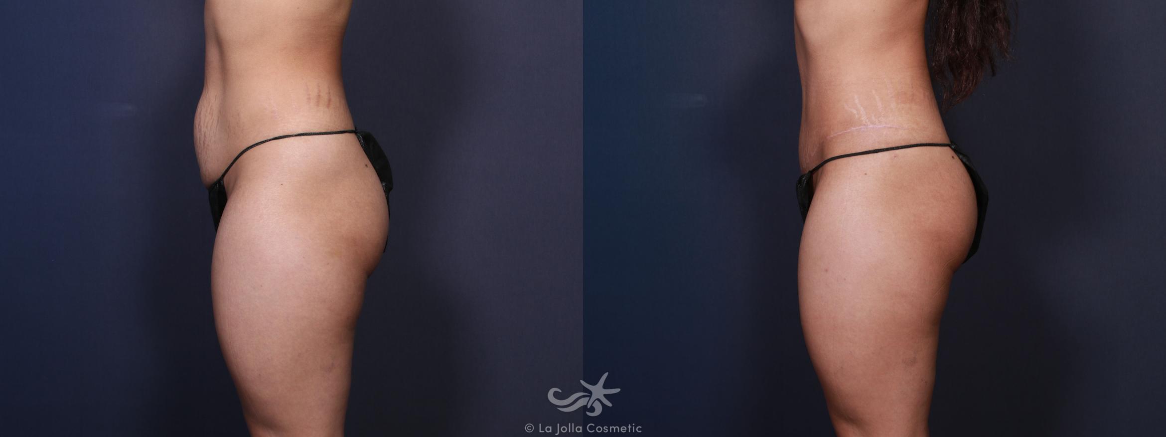 Before & After Tummy Tuck Result 95 Left Side View in San Diego, CA