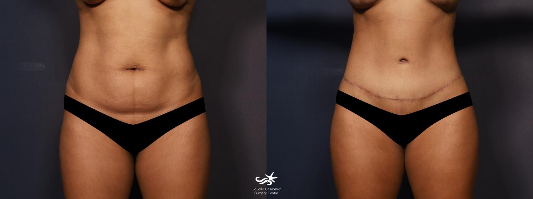 Before & After Tummy Tuck Result 951 Front View in San Diego, CA
