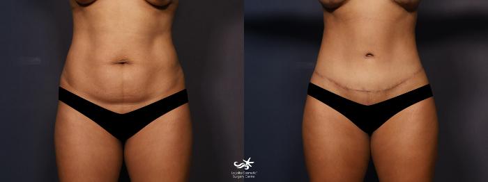 Case 52 - Tummy Tuck Revision Before and After Photo Gallery