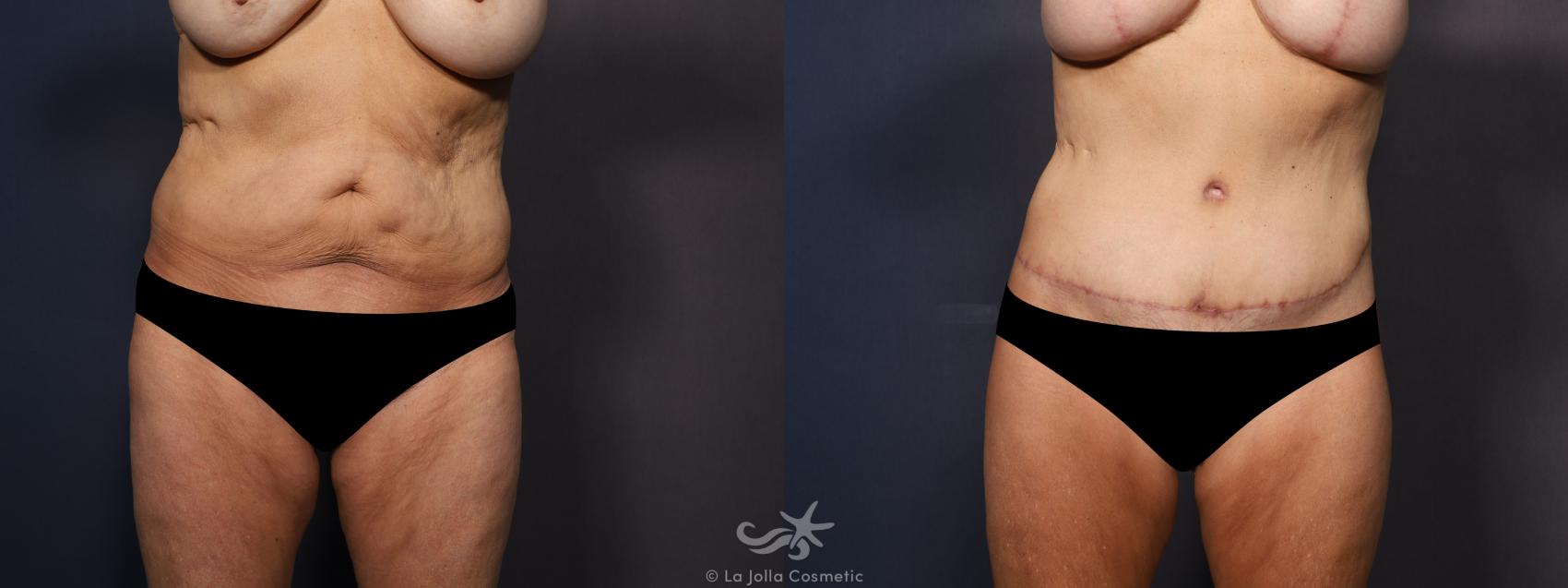 Before & After Tummy Tuck Result 958 Front View in San Diego, CA