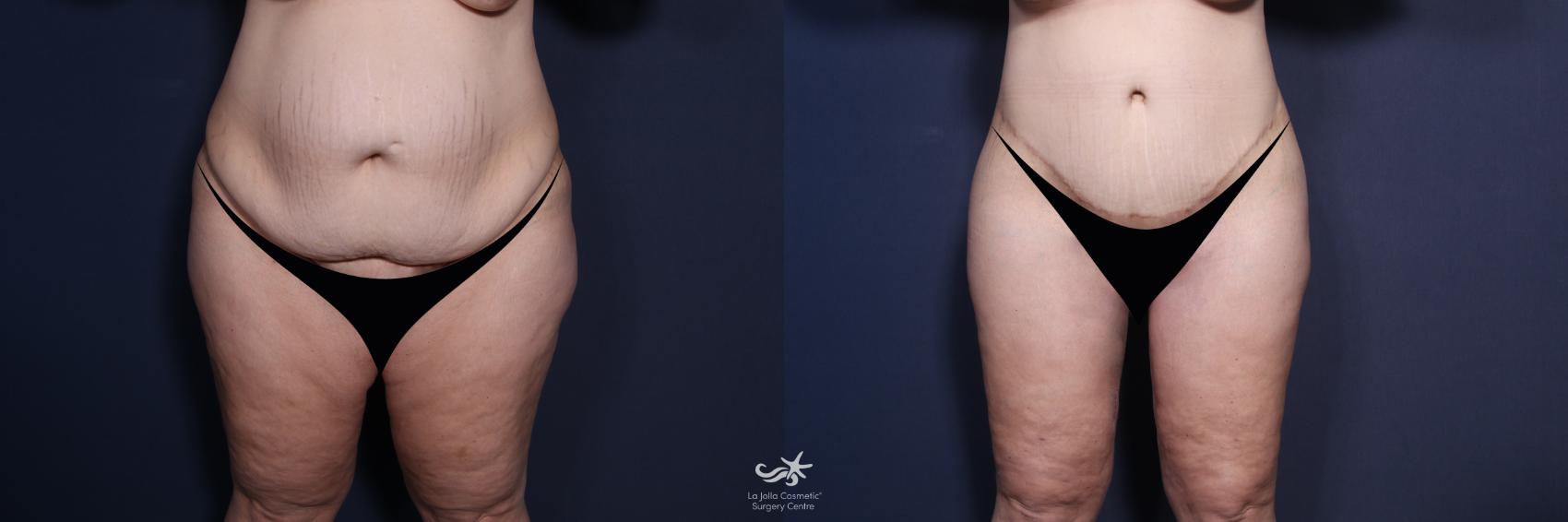 Before & After Tummy Tuck - Extended Result 171 Front View in San Diego, CA