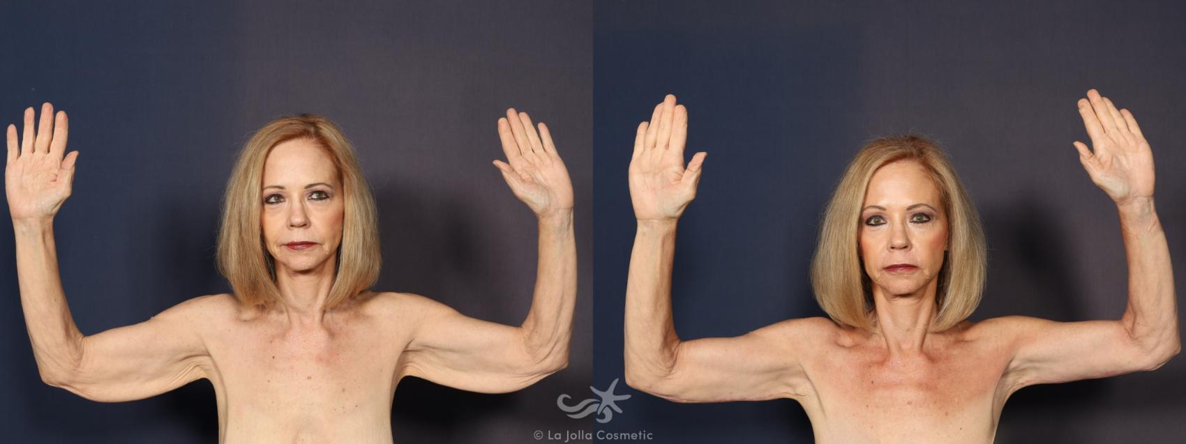 Before & After Upper Arm Lift Result 1099 Front View in San Diego, CA