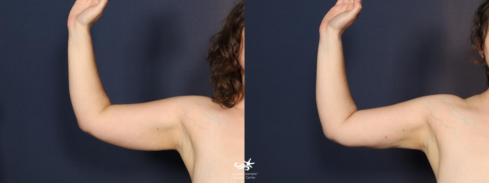 Before & After Upper Arm Lift Result 1117 Front View in San Diego, CA