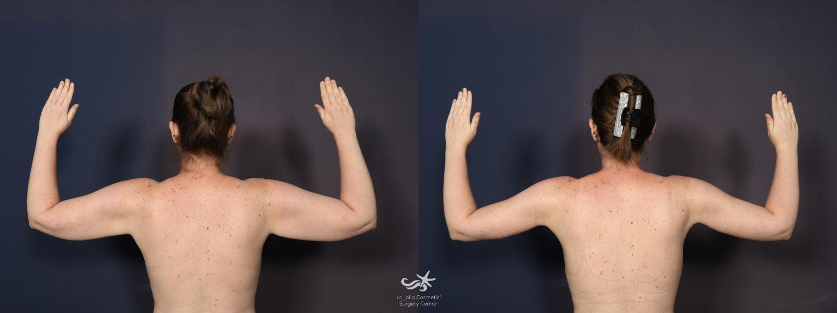 Before & After Upper Arm Lift Result 1200 Back View in San Diego, CA