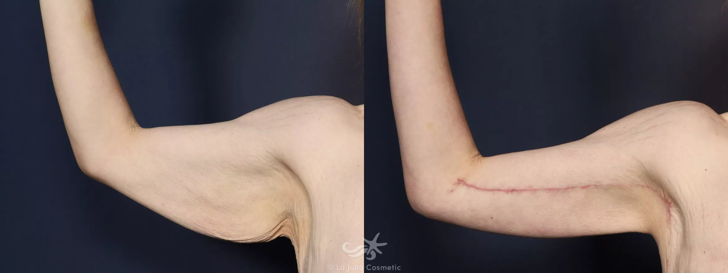 Before & After Upper Arm Lift Result 747 Front View in San Diego, CA