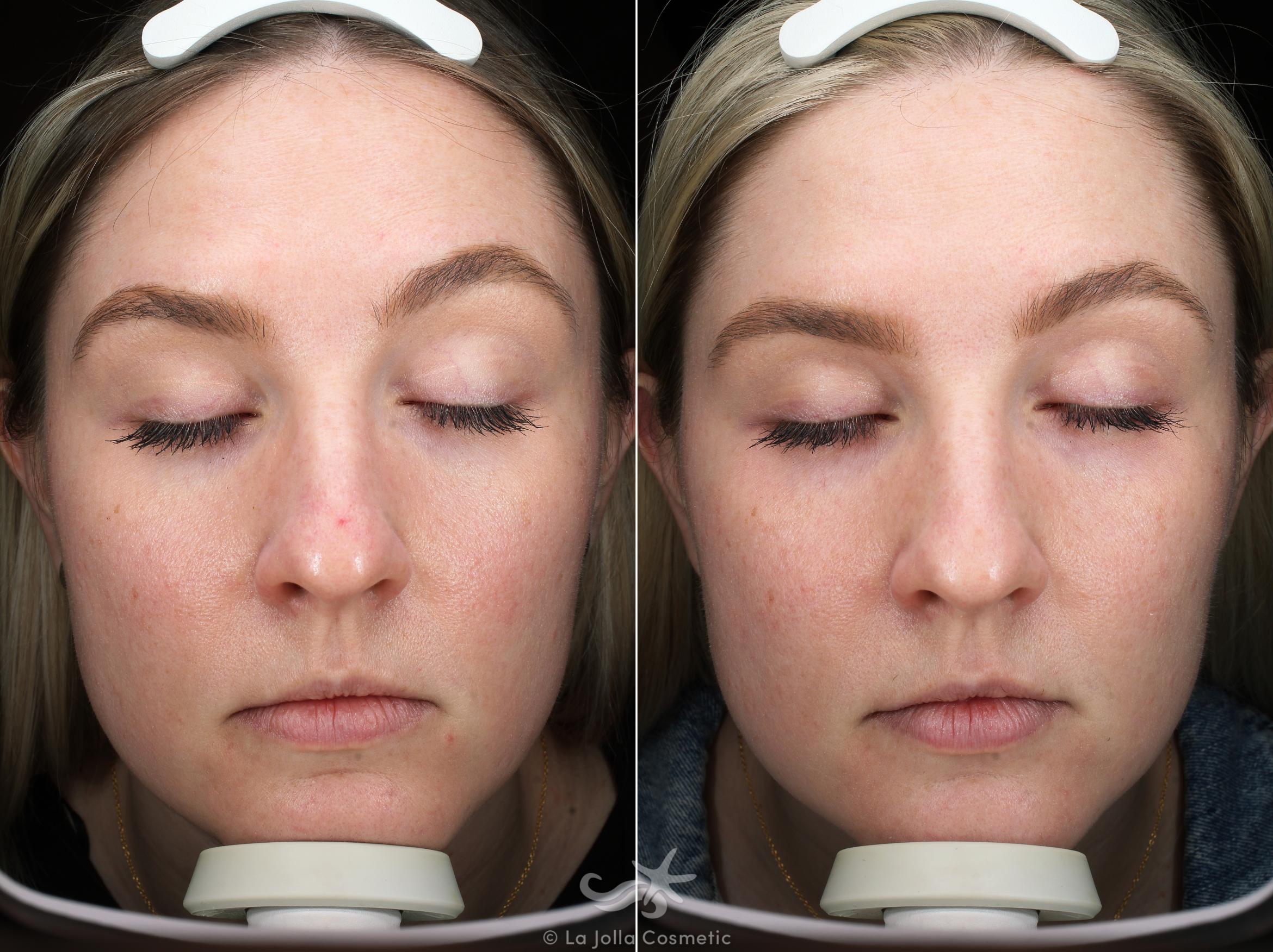 Before & After VBeam Laser Result 540 Front View in San Diego, Carlsbad, CA