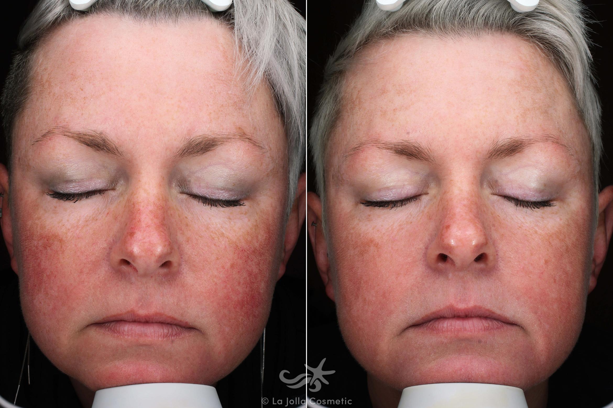 Before & After Laser Treatments Result 584 Front View in San Diego, CA