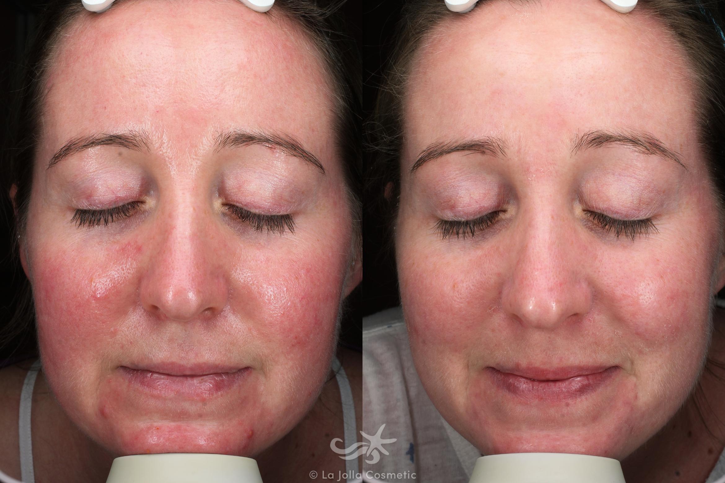 Before & After Laser Treatments Result 640 Front View in San Diego, CA