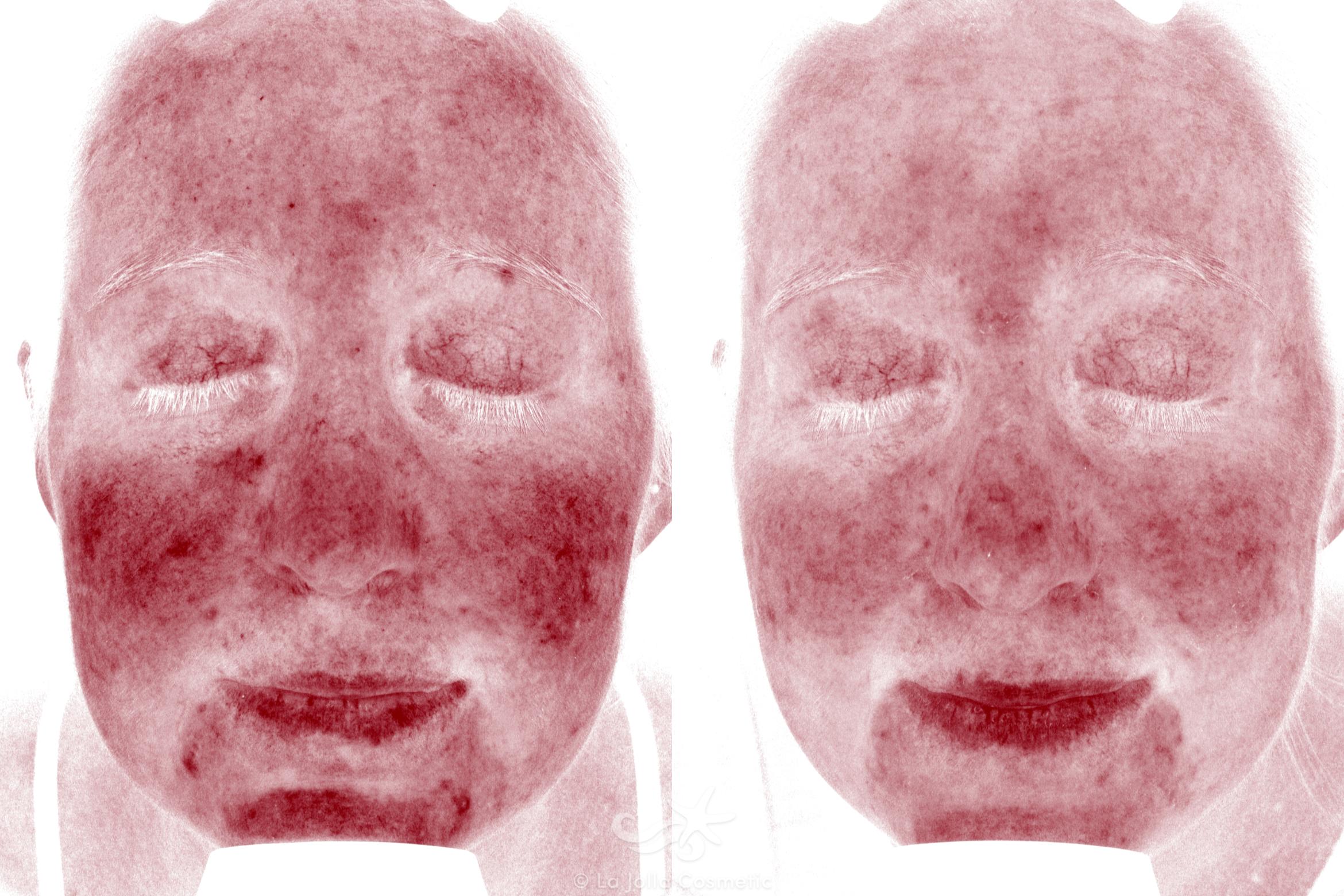 Before & After VBeam Laser Result 640 Red Spots Front View in San Diego, CA