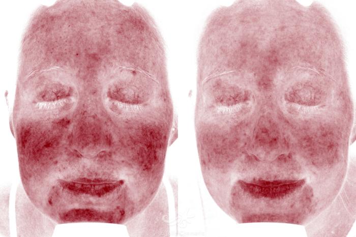 Before & After VBeam Laser Result 640 Red Spots Front View in San Diego, Carlsbad, CA