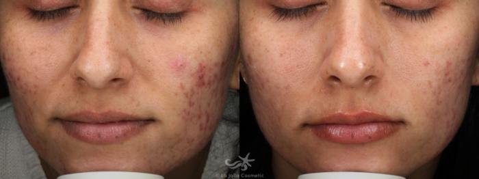 Before & After VBeam Laser Result 757 Front View in San Diego, Carlsbad, CA