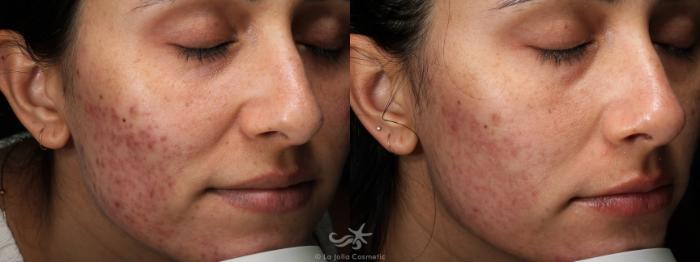 Before & After VBeam Laser Result 757 Right Oblique View in San Diego, Carlsbad, CA